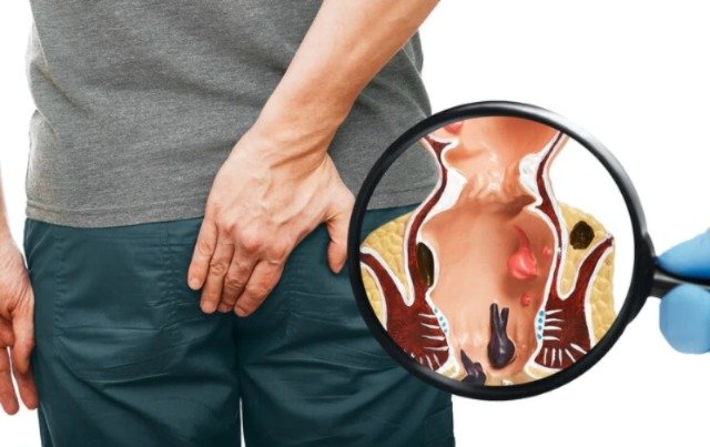 Centre For Piles & Fistula Treatment